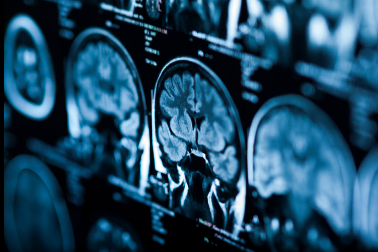 IGF-1 for Brain Growth and Repair